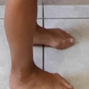 Lucia_halluxvalgus MYM